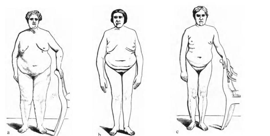 classification of eunuchoid body shapes