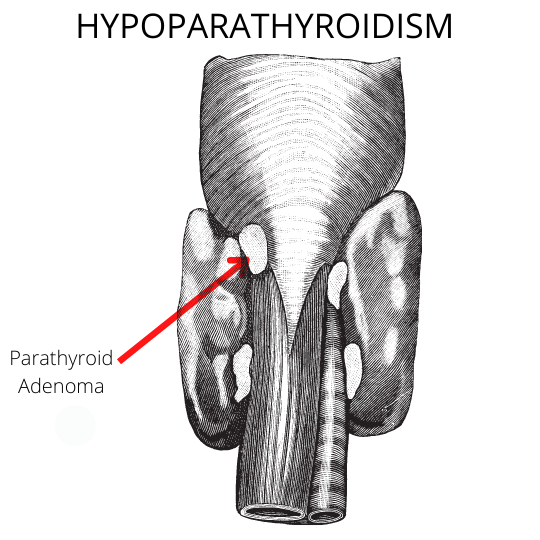 Hypoparathyroidism treatment My Endo Consult