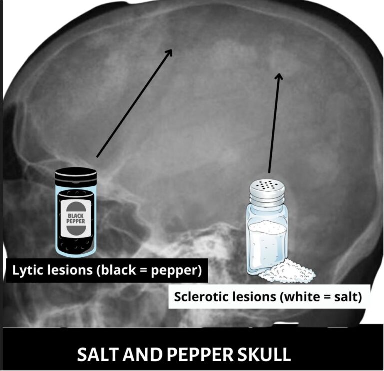 Salt And Pepper Appearance Mri at Kelly Hornick blog